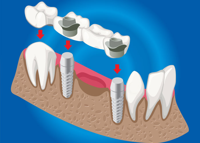 Imagen de como es un implante dental