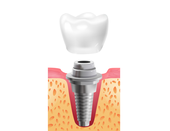 Imatge Il·lustrativa d'implant dental