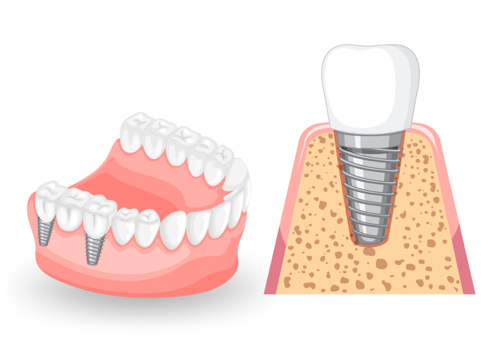 Imatge il·lustrativa de com es fa un pont sobre implant