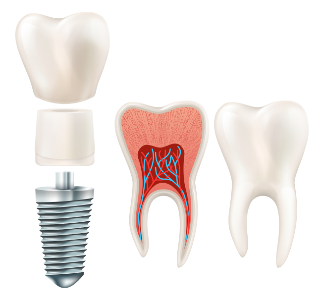 Imatge il·lustrativa de com és un implant unitari