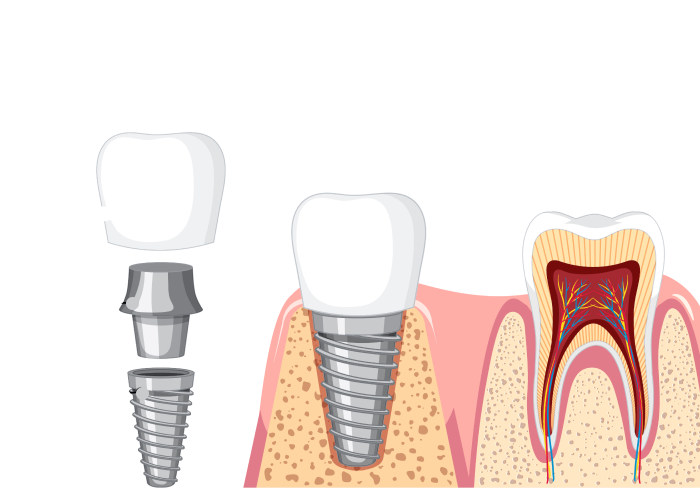 Imatge il·lustrativa de com és un implant unitari